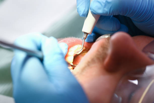 Best Urgent Care for Lost Fillings or Crowns in Wormleysburg, PA